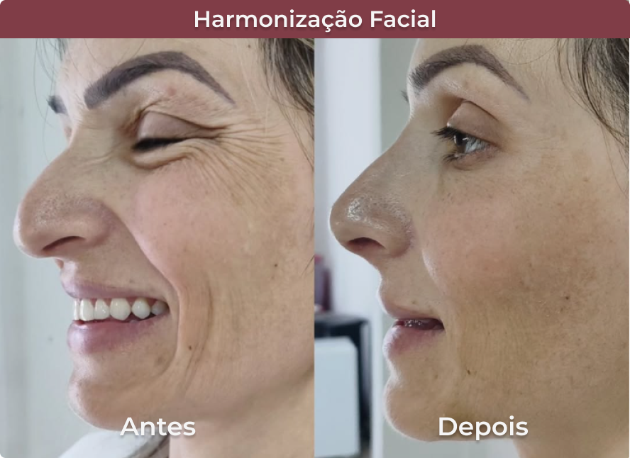 HarmonizacaoFacial