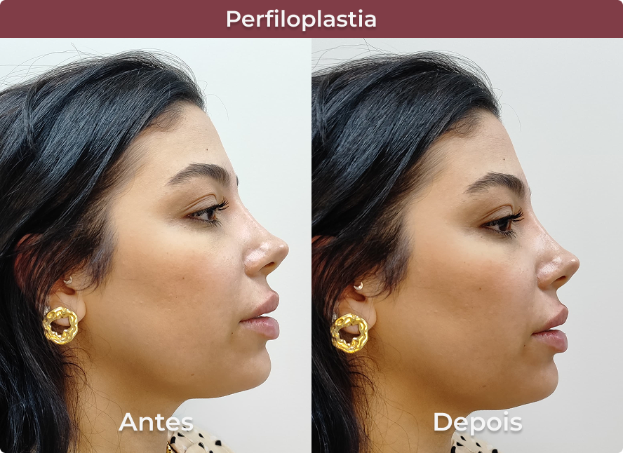 Perfiloplastia 2