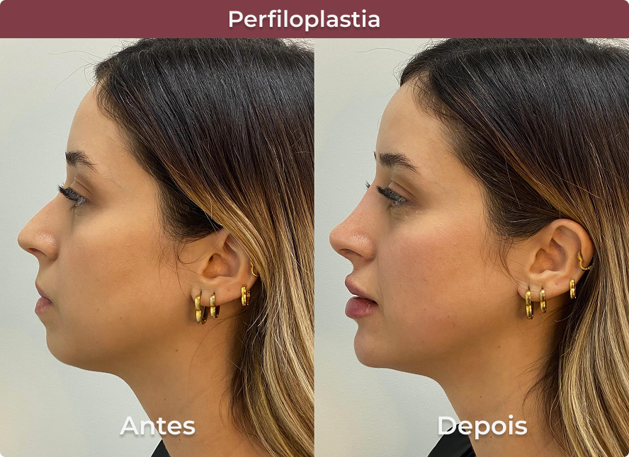 Perfiloplastia