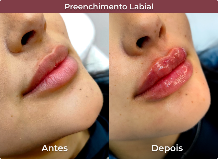 Preenchimento labial