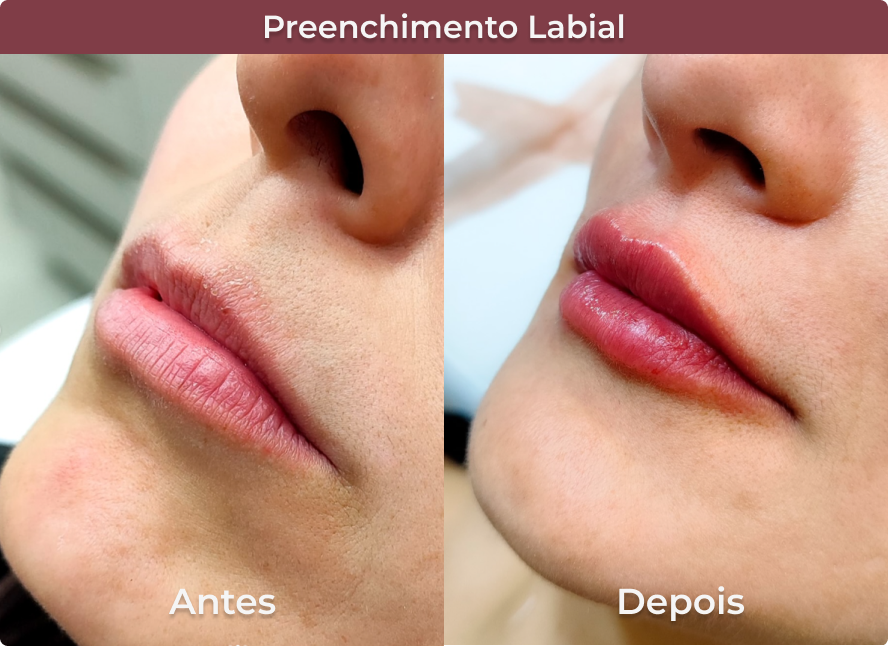preenchimento labial 2